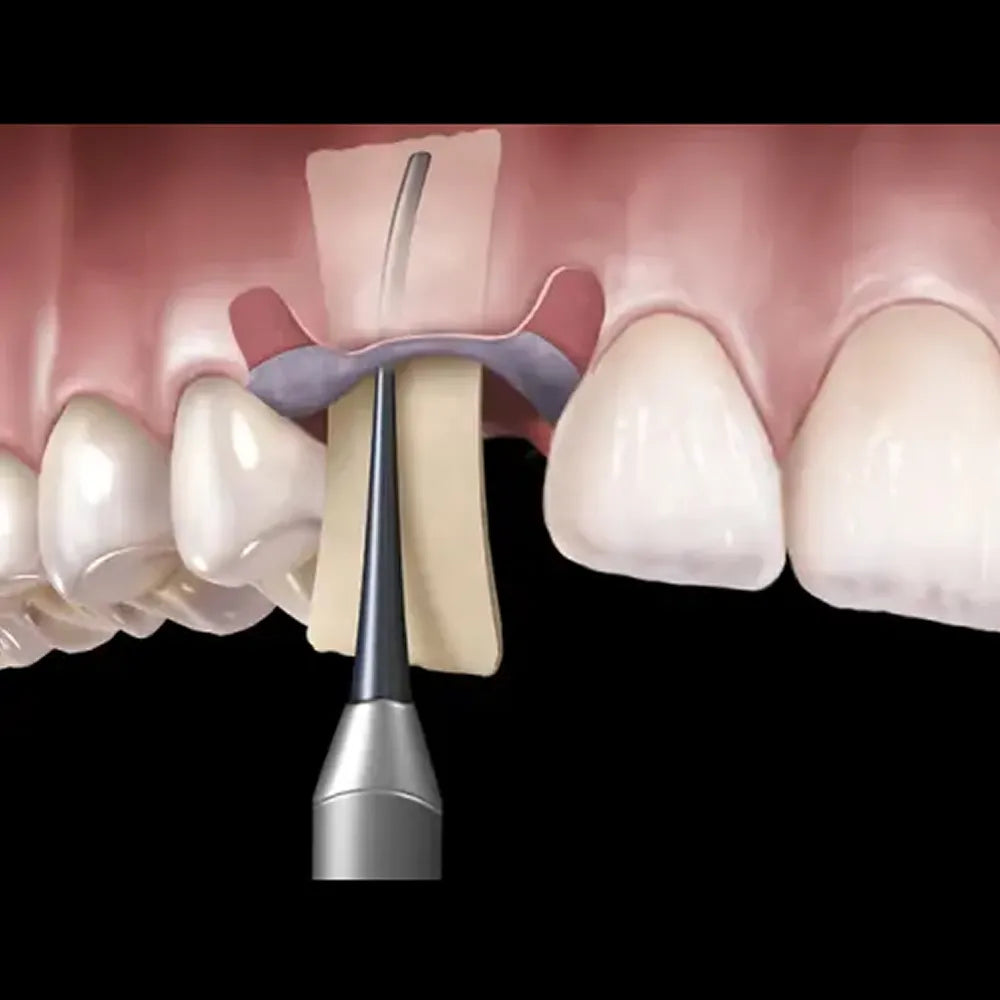 GDC Membrane Placement Instrument (Pmpis)