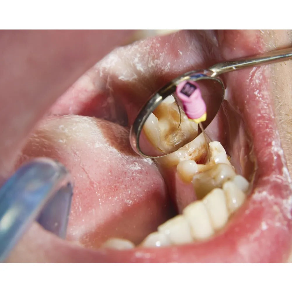 GDC Mouth Mirror Tops Magnified Pack Of 12 - 5 (Mmtm5)