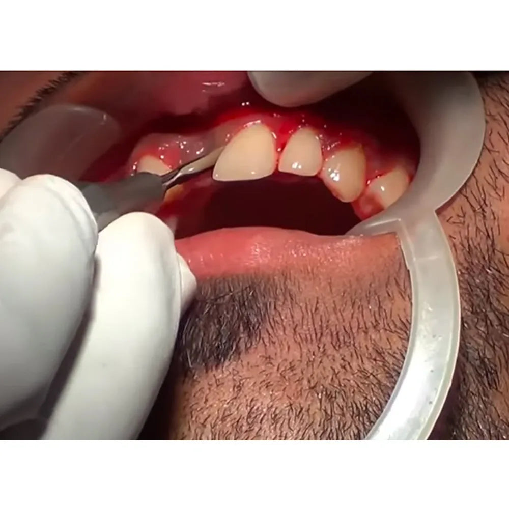 GDC Periotome #4 (P2)