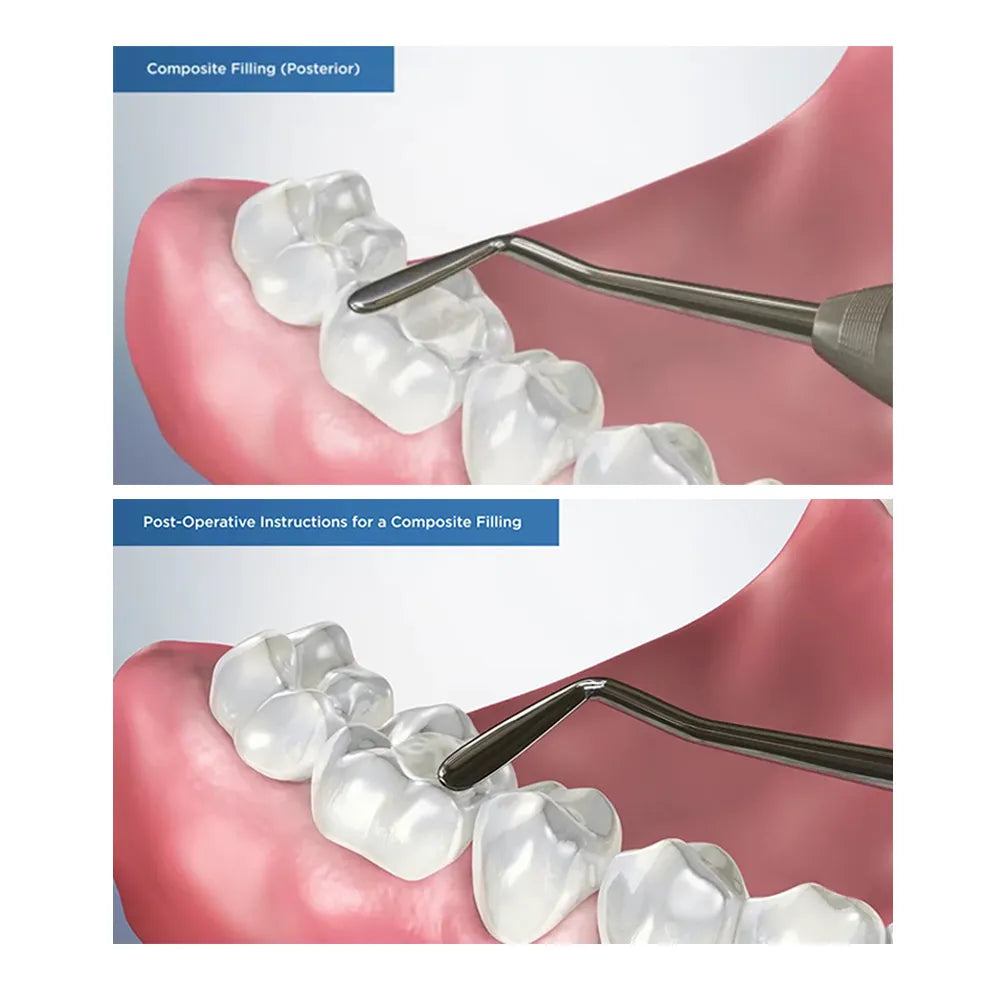 GDC Plastic Filling Instrument - 4 (PF2)
