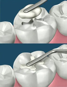 GDC Restore Hand Instruments