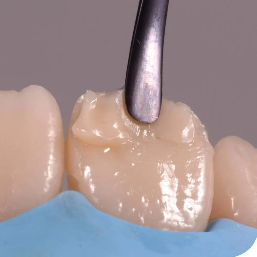 GDC Teflon Coated Composite Anterior Placing (Tncipcl)