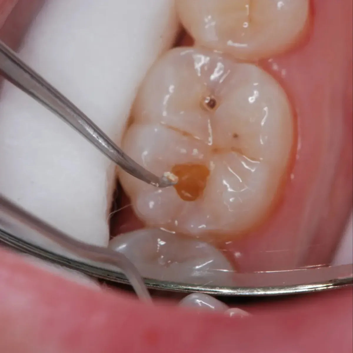 GI Dental Spoon Excavator