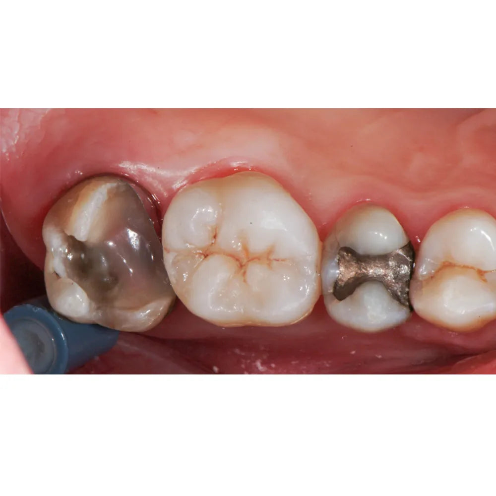 Garrison Dental ReelMatrix Margin Elevation Matrices (RM500H) - Pack of 50