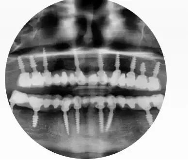 Impact Compressive Dental Implant 3.75 mm