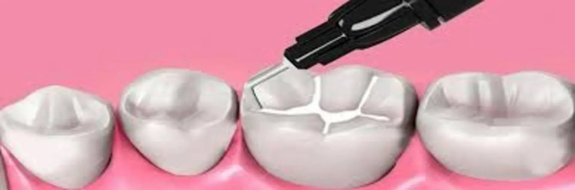 Ivoclar Tetric N-Flow Bulk Fill Composite IVA