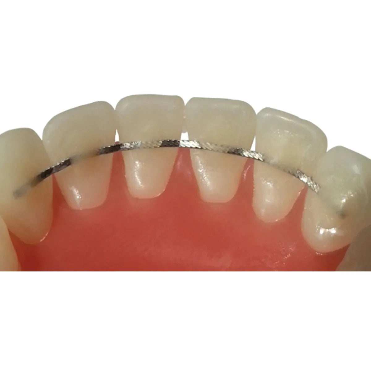 JJ Ortho Universal Lingual Retainers