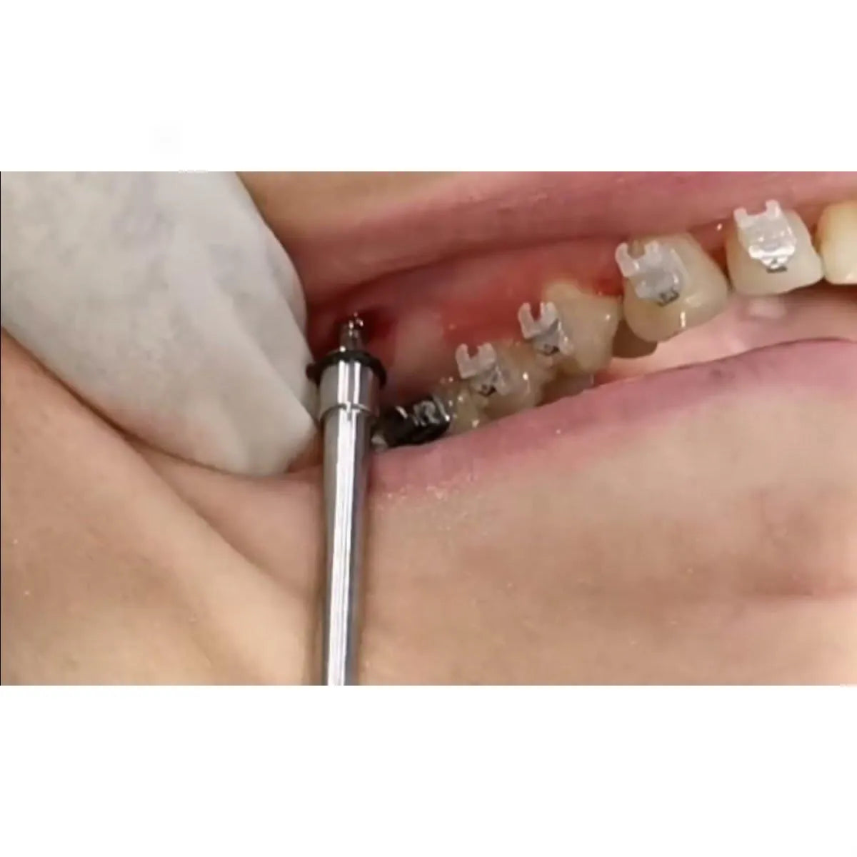 JJ Ortho Infrazygomatic Screw Implants