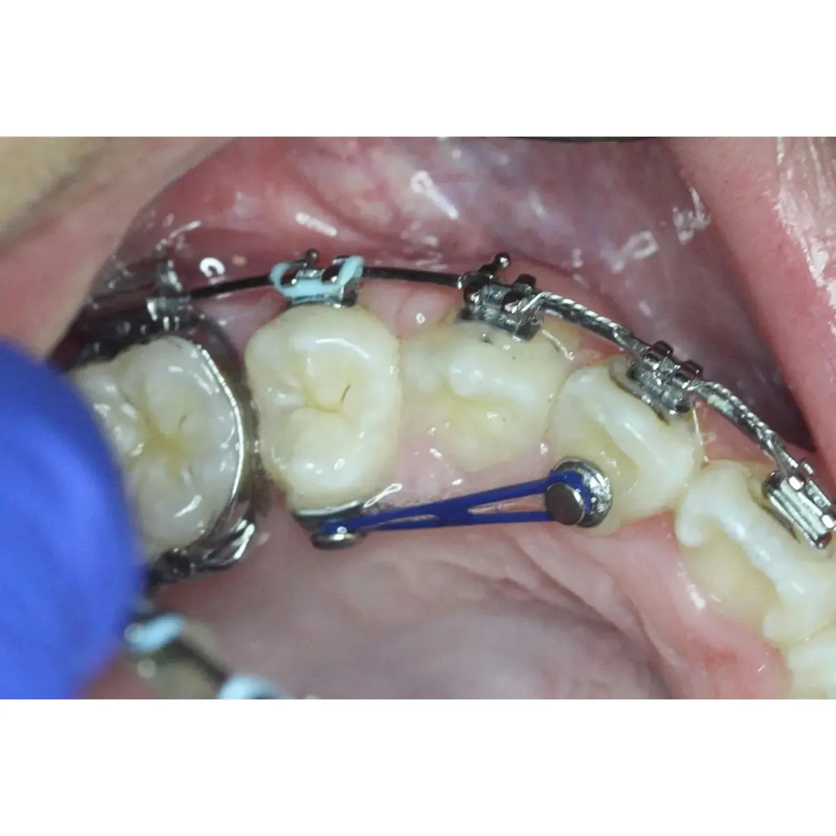 
JJ Ortho Weldable Lingual Button - Flat 3.5mm (60.01.09)