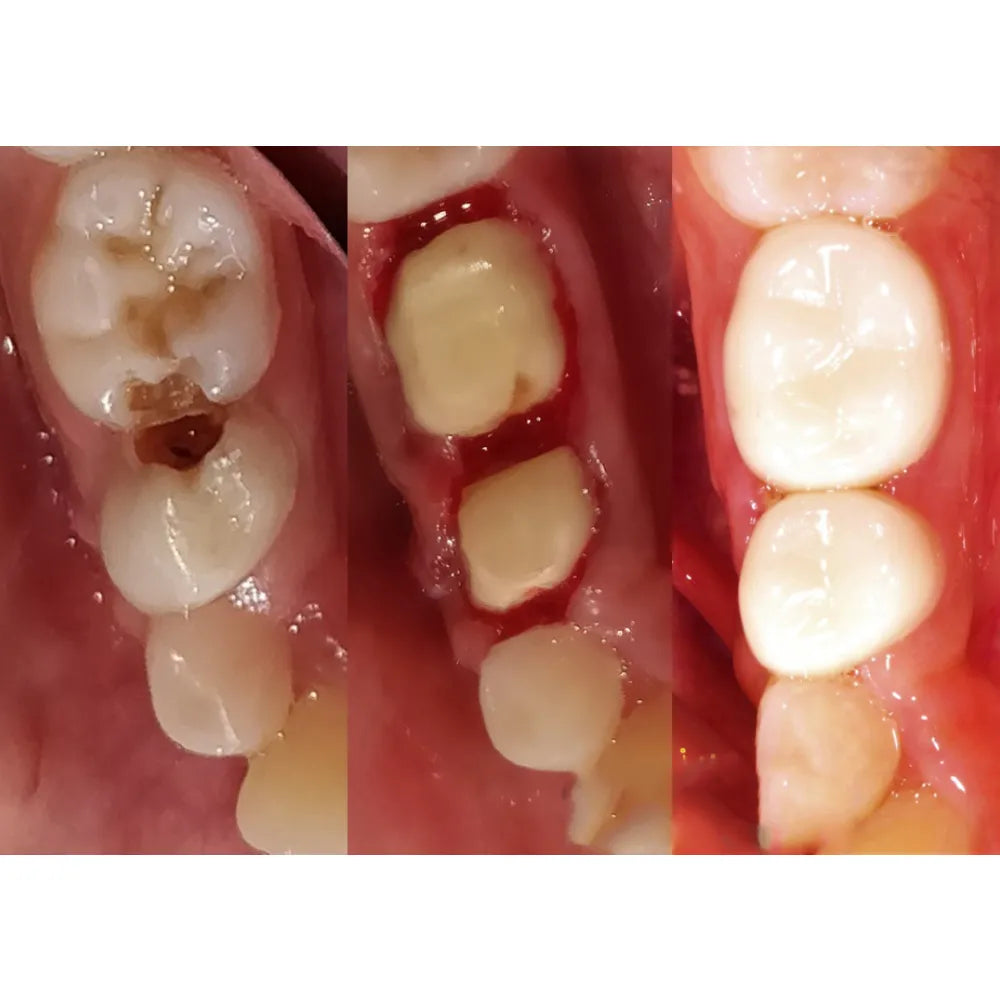 Kids-e-Crown Zirconia Upper Left 1st Molar Refills