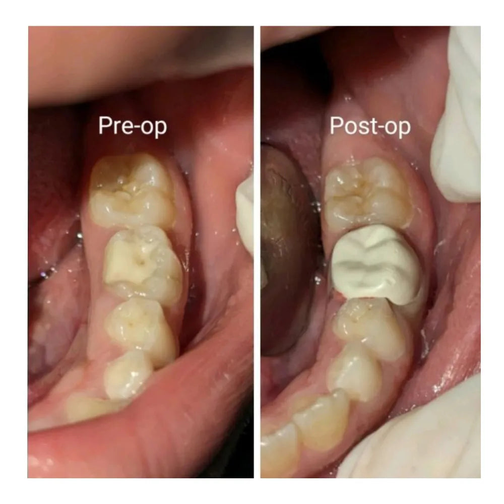 Kids-e-Dental BioFlx Lower Left 1st Molar Crowns Refills