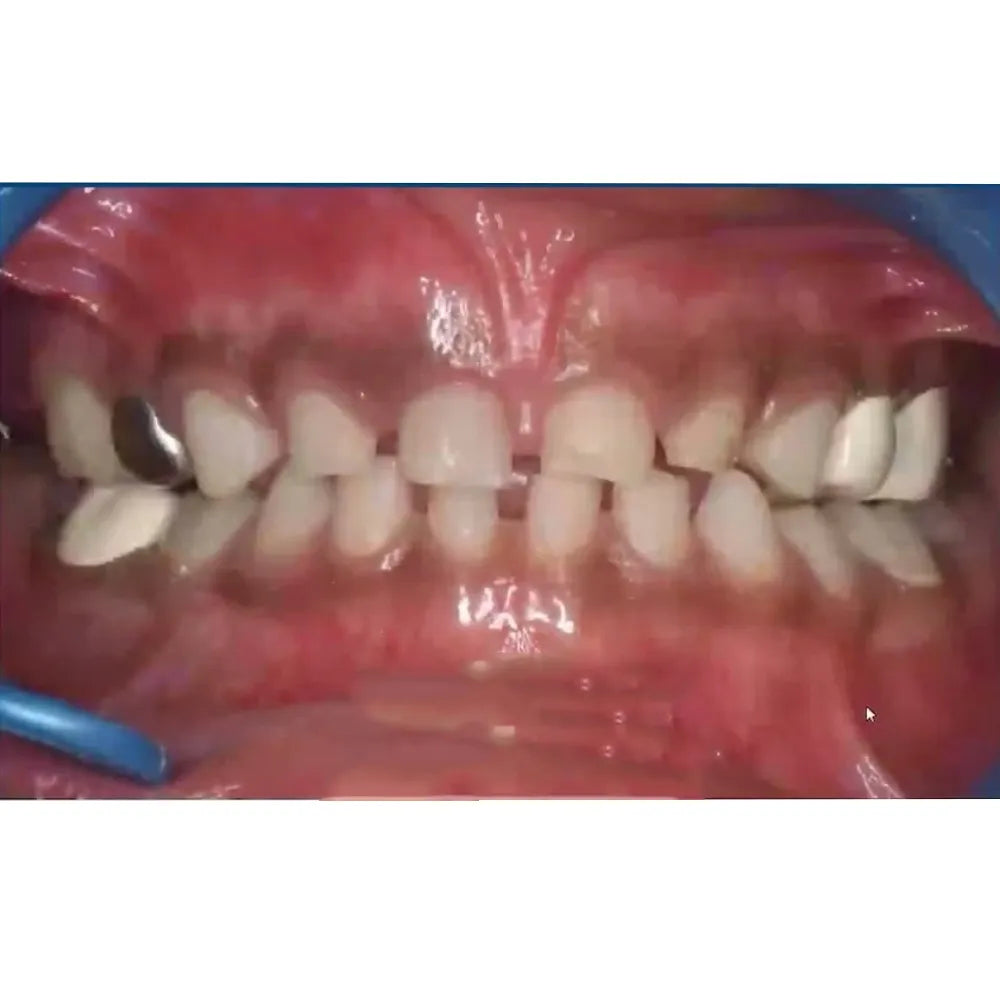 Kids-e-Dental BioFlx Upper Left 1st Molar Crowns Refills