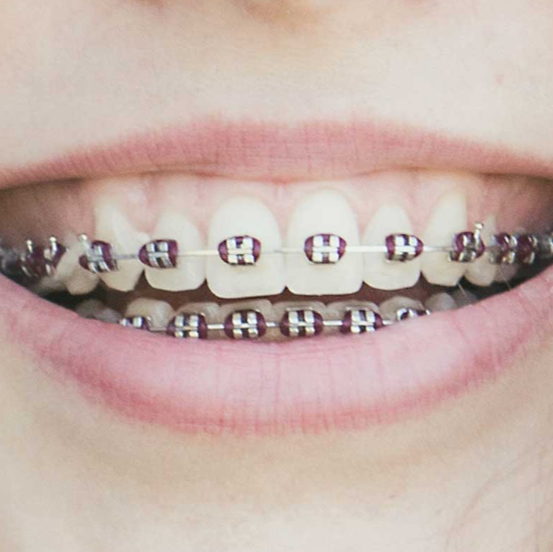 Metro Orthodontics Archwire Sleeve Orthodontic Accessory