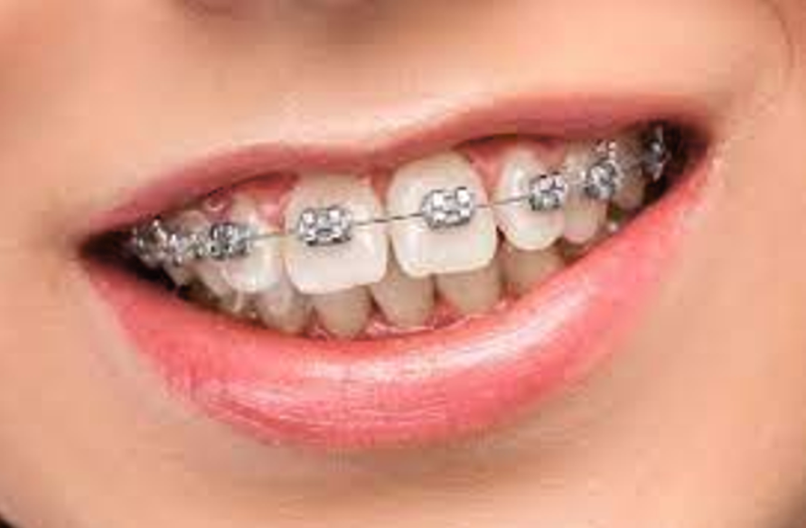 Metro Orthodontics Gold Series Pack of 20 Metal Conventional Brackets