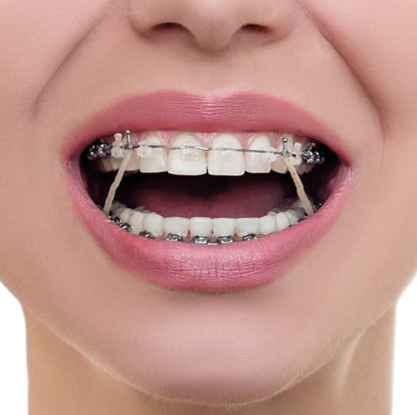 Metro Orthodontics Intra Oral Ortho Elastics