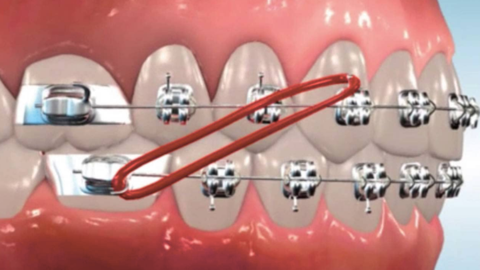 Metro Orthodontics Intra Oral Ortho Elastics