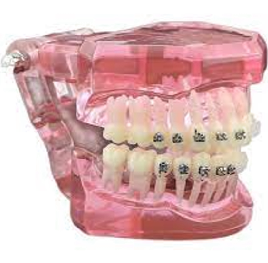 Metro Orthodontics Pink Series Pack of 20 Ceramic Conventional Brackets