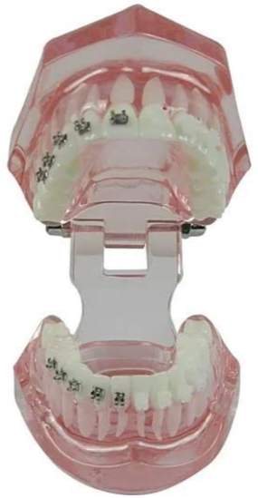 Metro Orthodontics Pink Series Upper Only 5-5 022 Ceramic Conventional Brackets