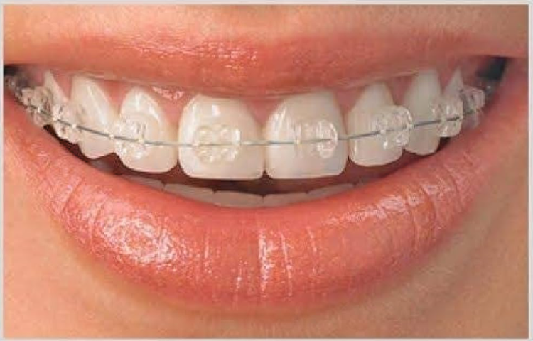 Metro Orthodontics Purple Series Pack of 20 Ceramic Conventional Brackets