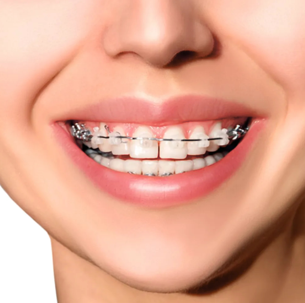 Metro Orthodontics Round Stainless Steel Archwires