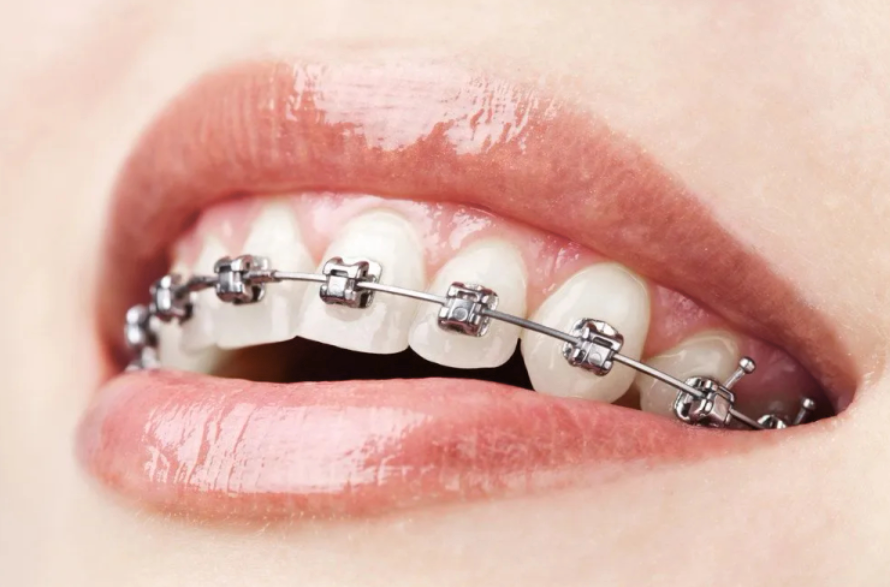 Metro Orthodontics Round Super Elastic NiTi Archwires - Upper 