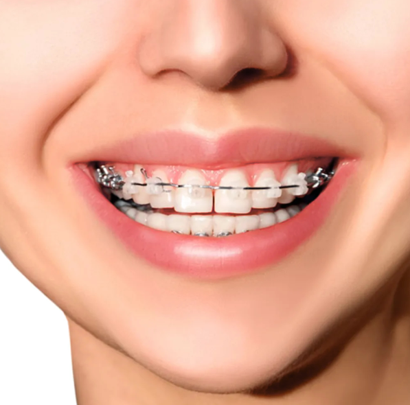 Metro Orthodontics Straight Length Round Stainless Steel Orthodontic Wires