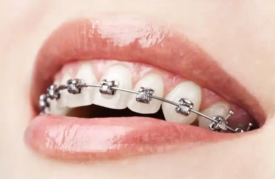 Metro Orthodontics Tapered Round Tooth Coloured Super Elastic NiTi Archwires