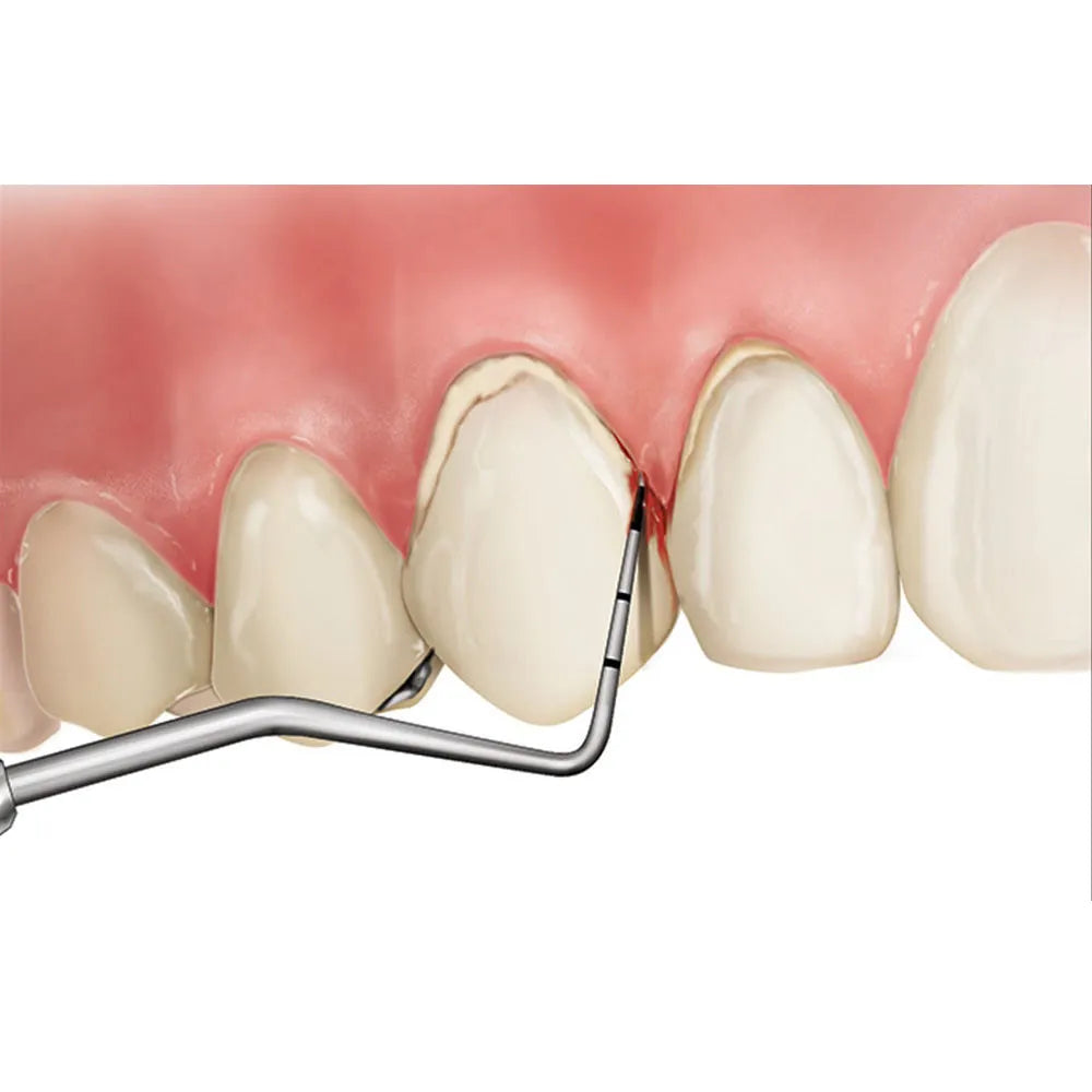 Oracraft Periodontal Probes
