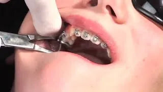 Ormco Advancsync 2 Class II Corrector