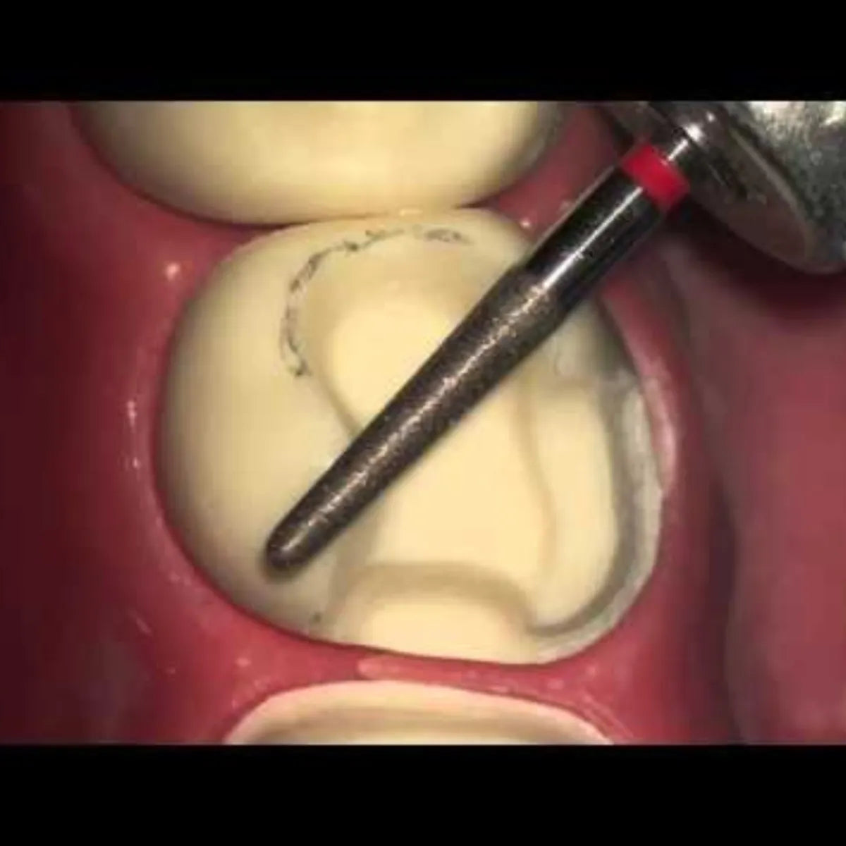 Pivo Inlay - Onlay Preparation Diamond Burs Kit (Set Of 8)