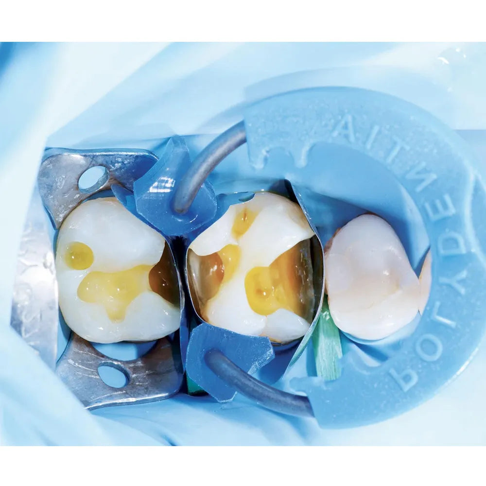 Polydentia MyQuickmat Classico Sectional Matrix Kit & Refills