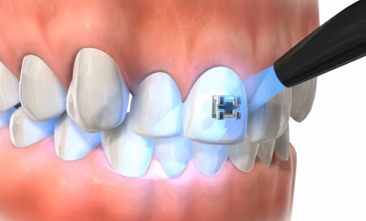 Prevest Denpro Fusion Crysta Adhesive - Trial Pack (10022)