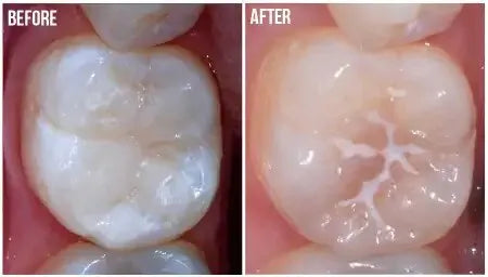 Prevest Denpro PF Seal Pit and Fissure Sealant (20012)