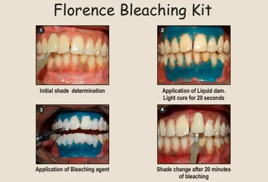 Prevest Florence Teeth Whitening Kit