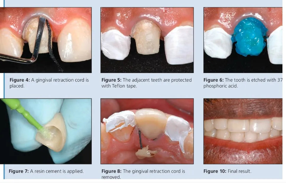 Prevest Fusion Self Lute