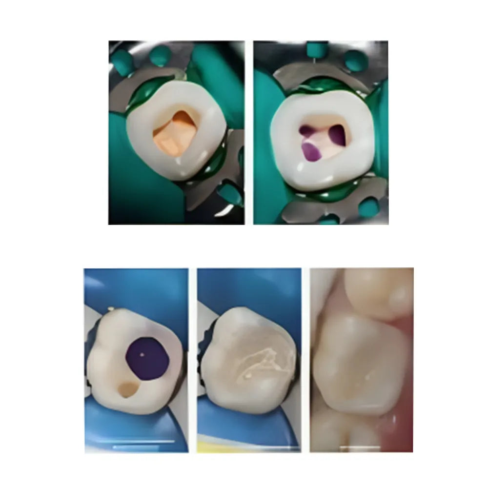 Prime Dental PurpleSeal Flowable Composite For Orifice Sealing