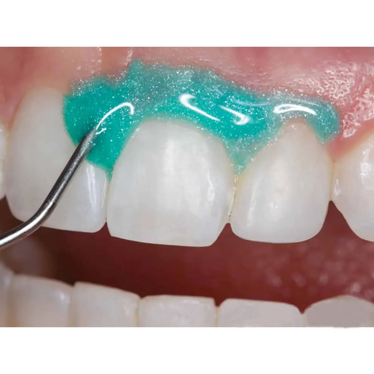 Prime Dental Gingisafe Light Cure 1