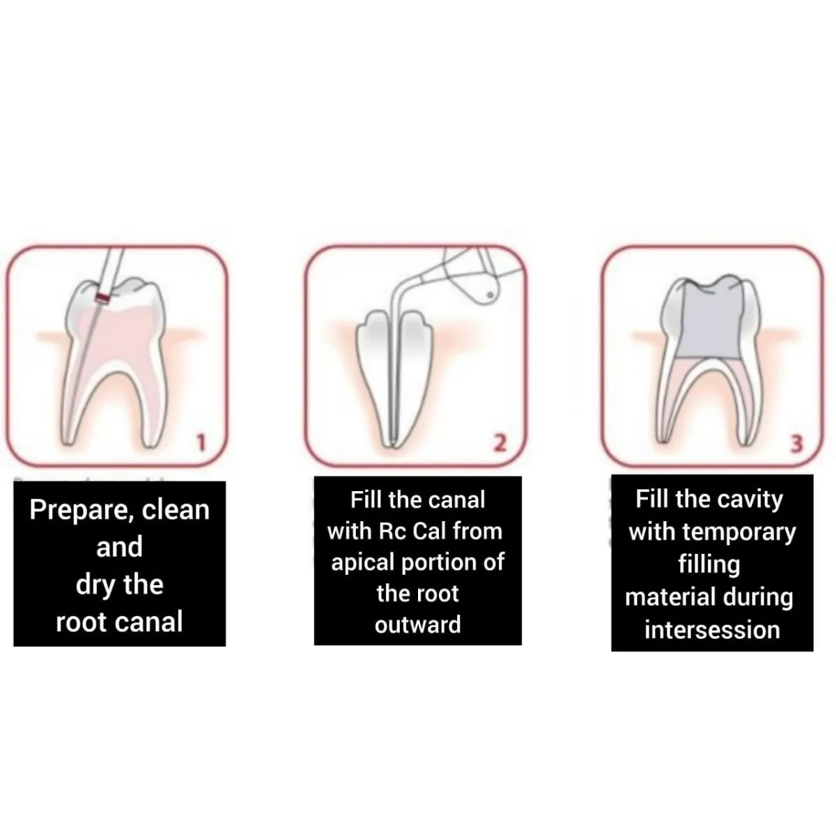Prime Dental Rc Cal