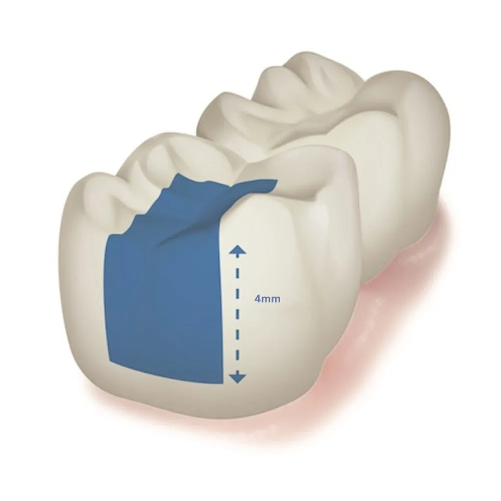 Prime Dental Restorite Bulk Fill Kit (Flowable)
