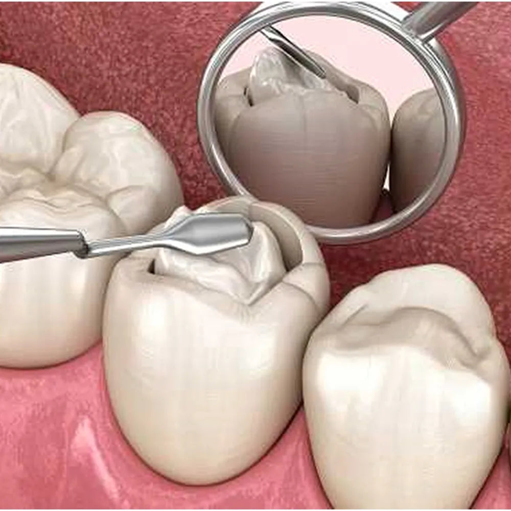 Prime Dental Restorite Bulk Fill Kit (Packable)