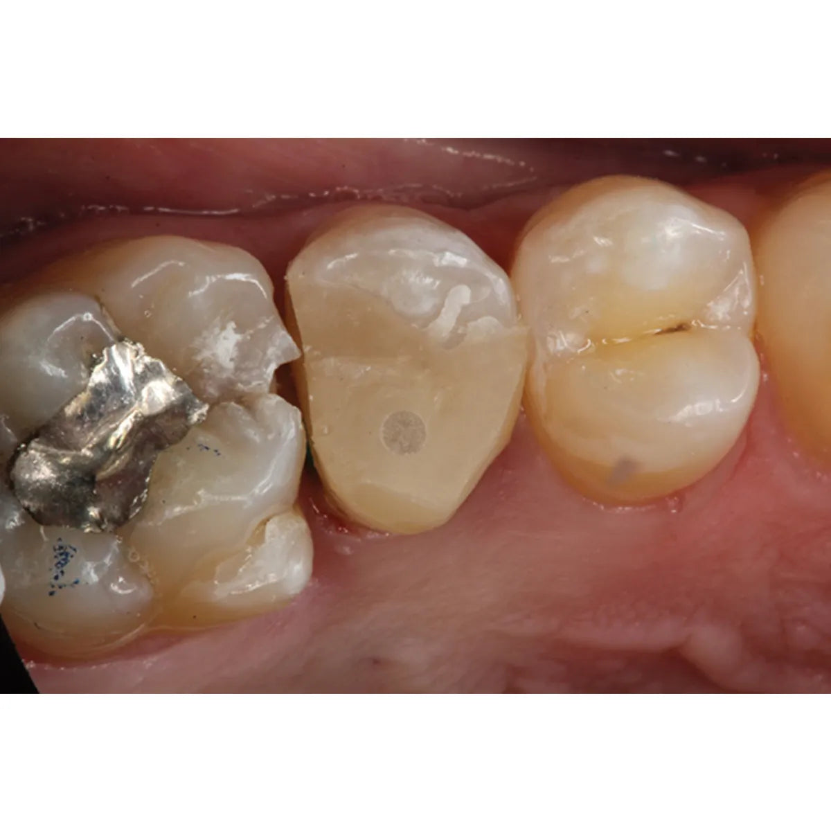 Prime Dental Restorite Core Build-Up