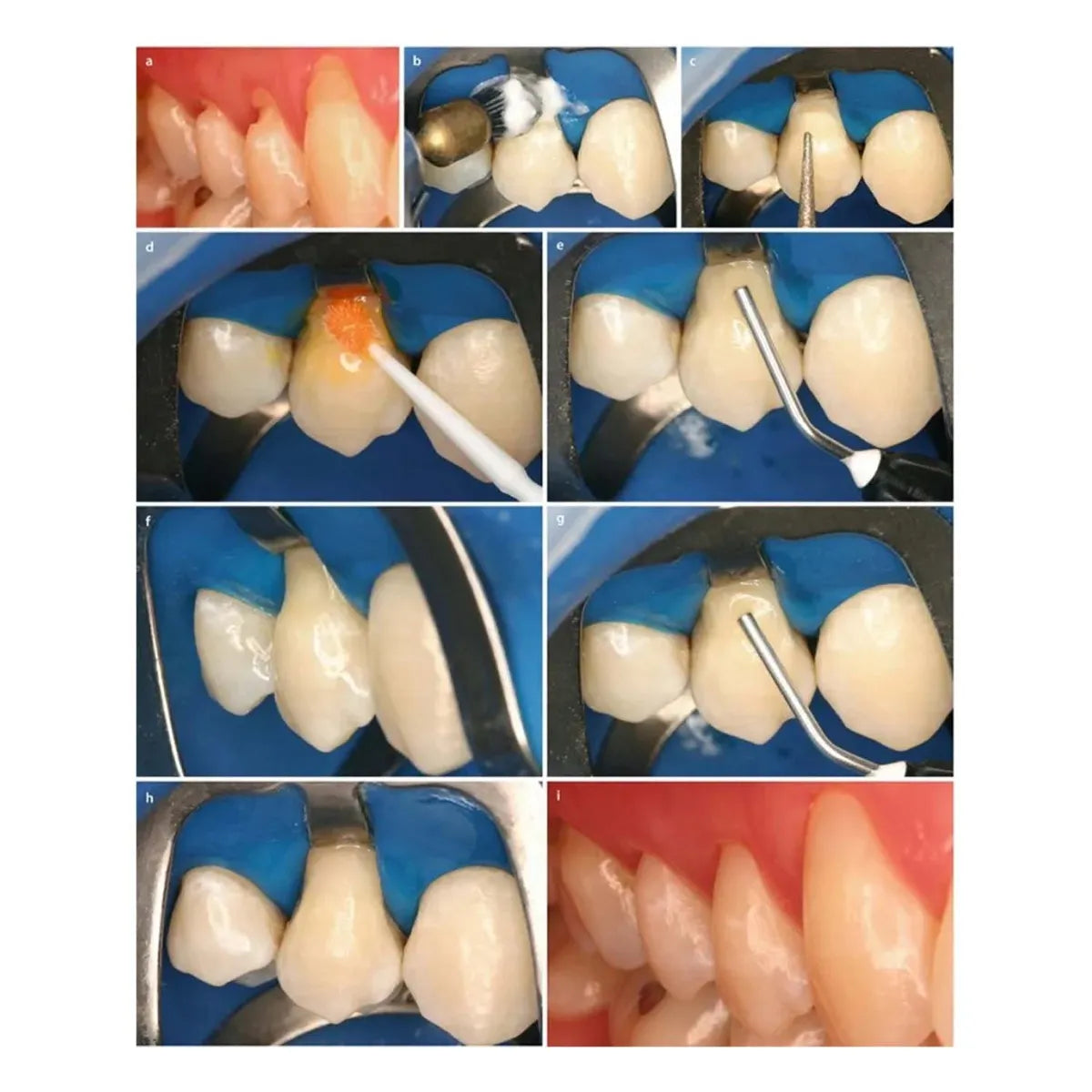 Prime Dental Restorite Flow Viscous Composite