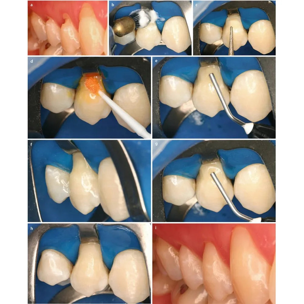 Prime Dental Restorite Flow Viscous Kit