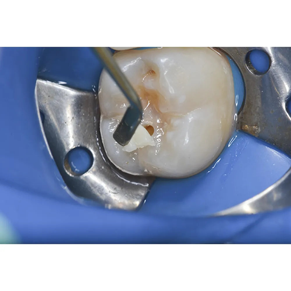 Prime Dental Restorite Micro Hybrid Kit