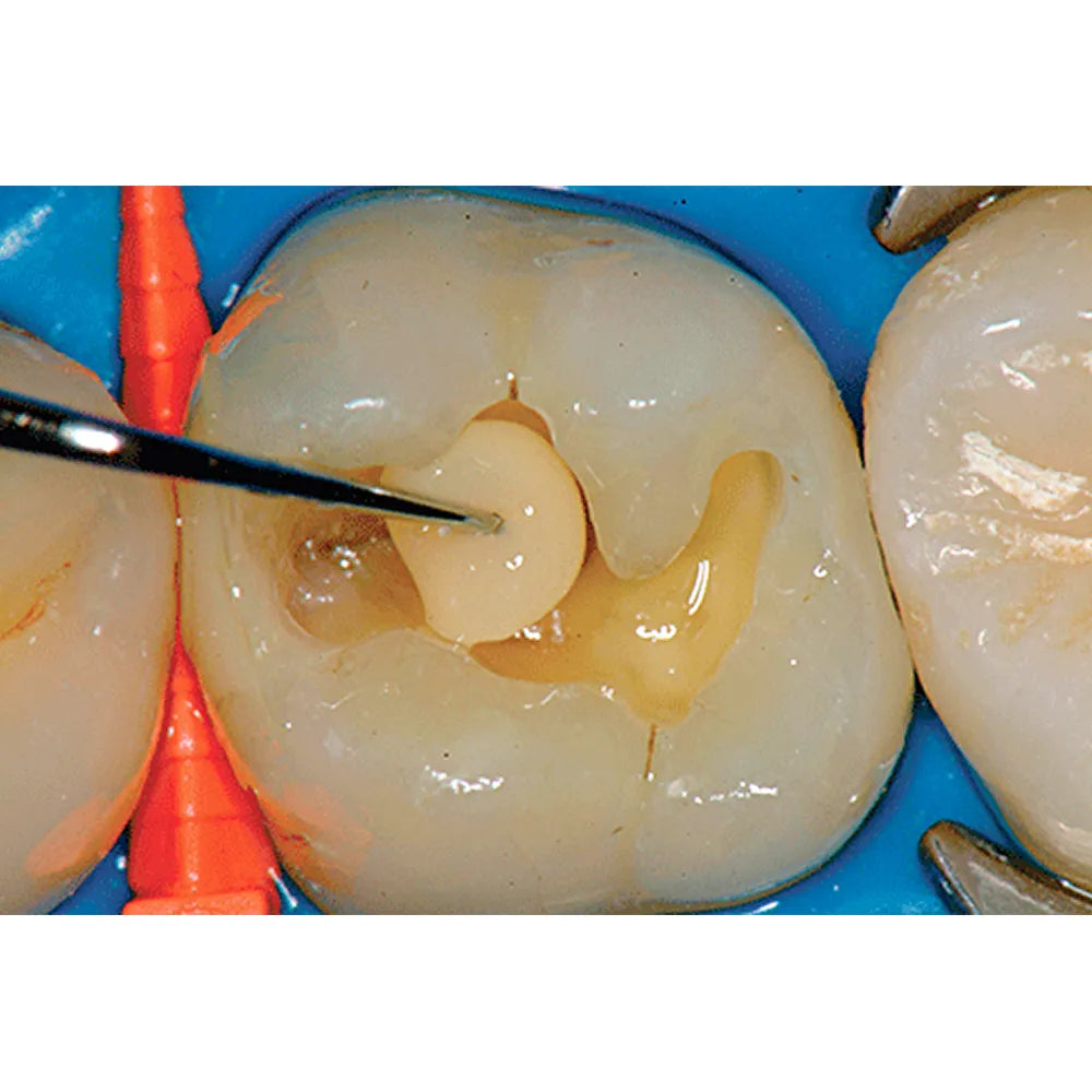 Prime Dental Restorite Micro Hybrid Kit
