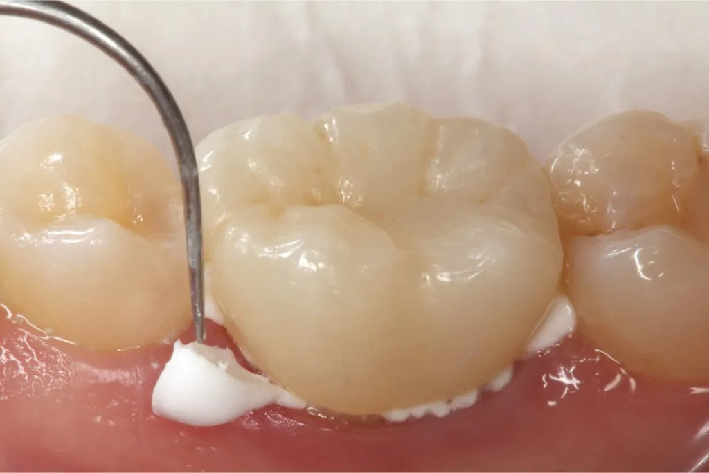 Pyrax Glass Ionomer Cement - Lute Type I