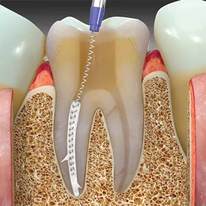 SafeEndo BioActive RCS