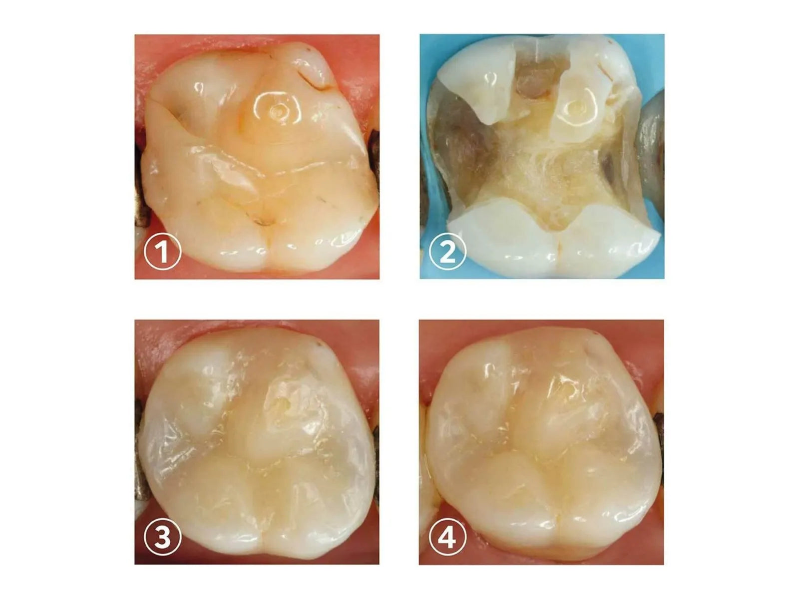 SafeEndo ReCreate LC