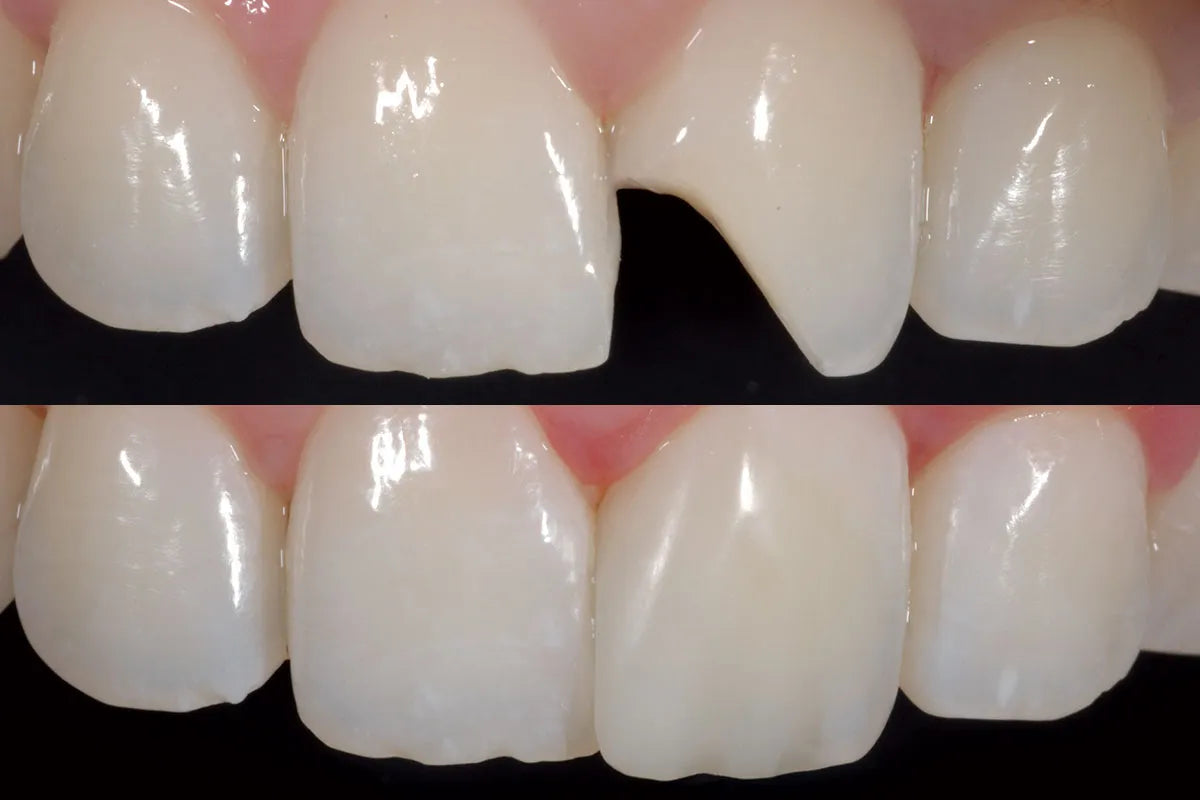 SafeEndo ReCreate LC Flow