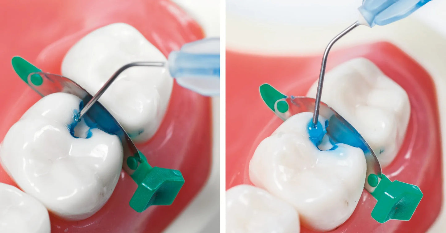 SafeEndo Smart Etch 5ml